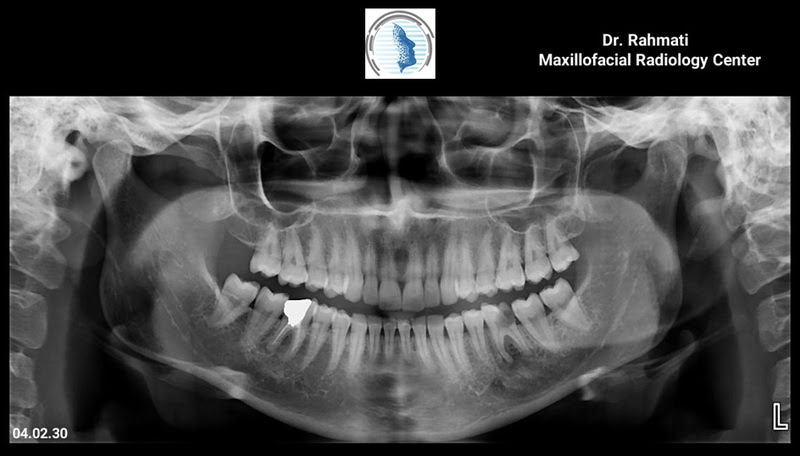 عکس CBCT چه تفاوتی با عکس معمولی دندان دارد؟