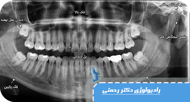 دندان نهفته چیست و چگونه تشخیص داده می‌شود؟ | راهنمای کامل پانورکس و CBCT