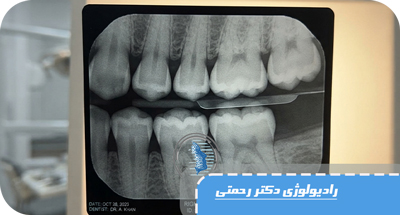 عکس بایت‌وینگ (Bitewing) چیست؟ کاربردها، مزایا و زمان انجام رادیوگرافی بایت‌وینگ | دکتر آزاده رحمتی 